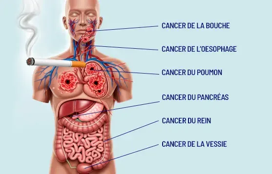 Cancers liés au tabac