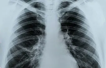 Radiographie